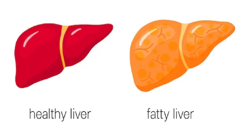 Fatty liver: फैटी लिवर के कुछ संकेत और बचने के उपाय