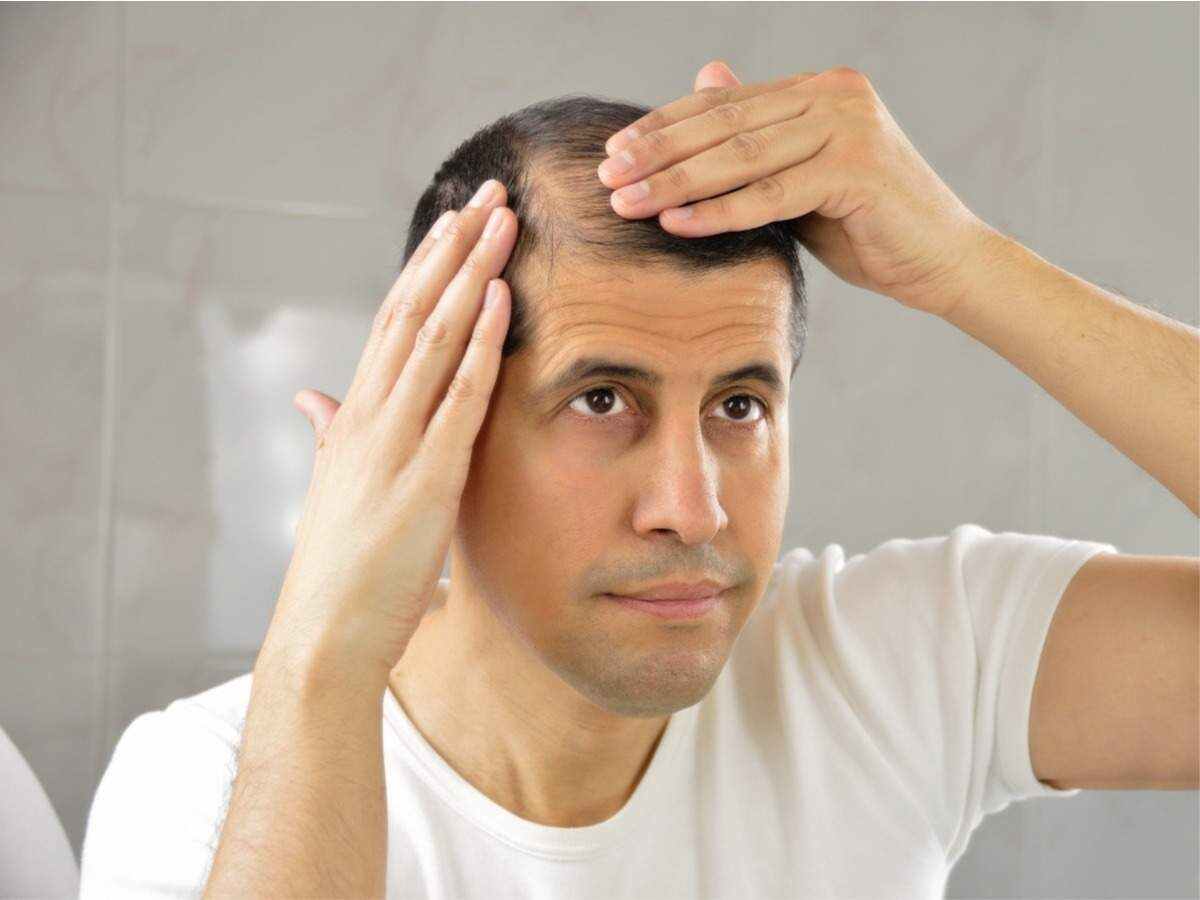 Male Baldness: पुरुष क्यों होते हैं तेजी से गंजे, जानिए  गंजेपन से बचने के उपाय