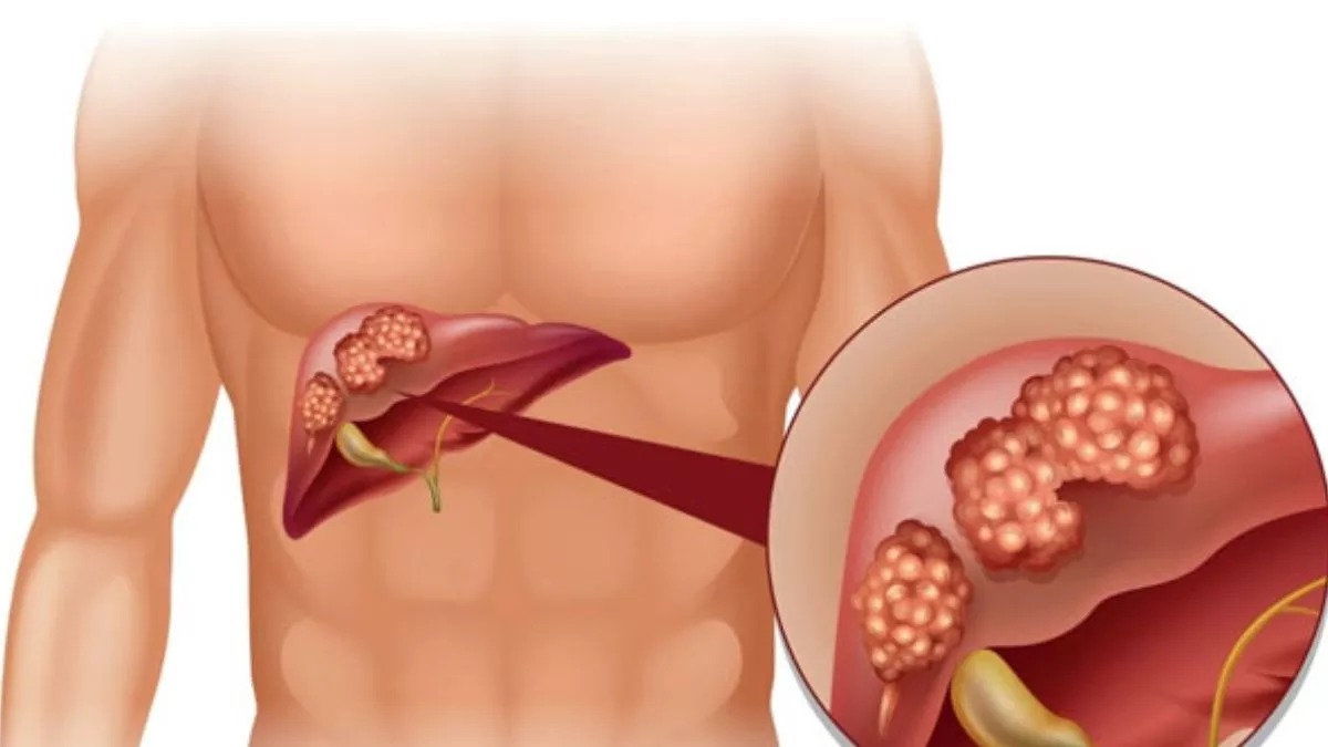 Liver Cancer : रिसर्च में दावा, 2024 तक लिवर कैंसर से होगी 55 फीसदी से अधिक मौतें