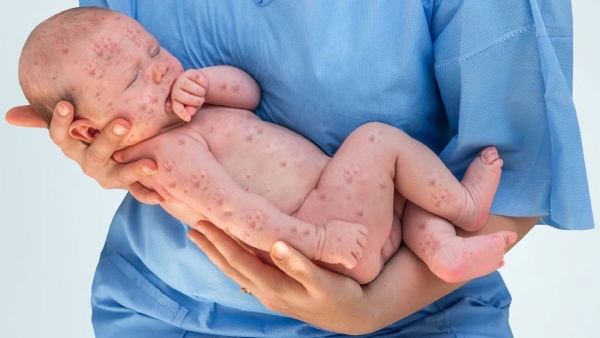 Measles Symptoms: बच्चों में तेजी से फैल रही है ये बीमारी, जानिए कैसे कर सकते है इससे बचाव