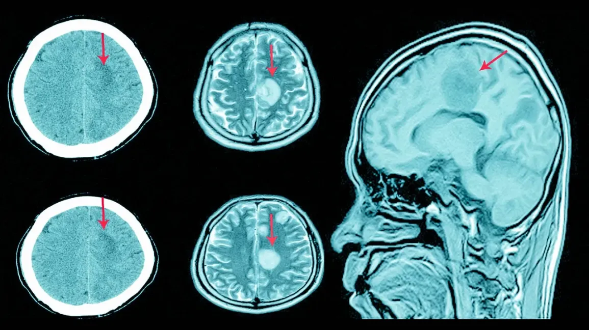 Subdural Hematoma: सबड्यूरल हेमाटोमा क्या है? जानें इसके लक्षण