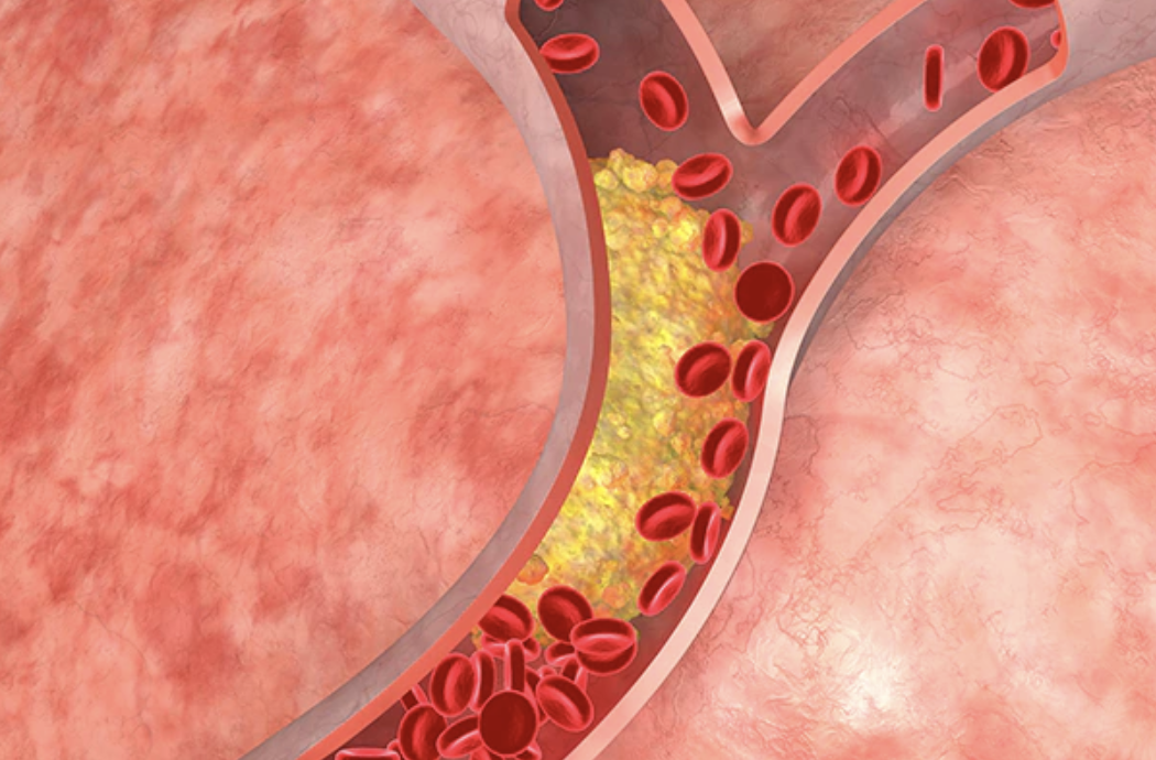 Cholesterol: कोलेस्ट्रॉल रोगियों को दूर रहना चाहिए इन चीज़ों से, नहीं तो हो सकती है गंभीर दिक्कत